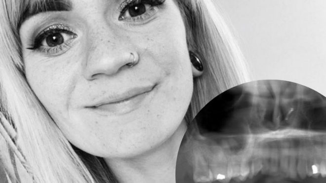 Newent woman who sued hospital wins £15,000 after losing tooth